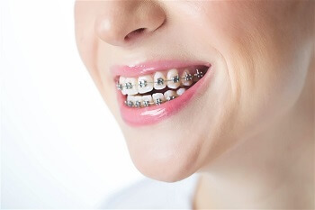 What is better, braces or clear aligners?