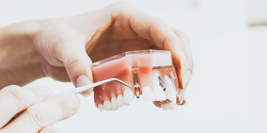 Dental Implants Kanata