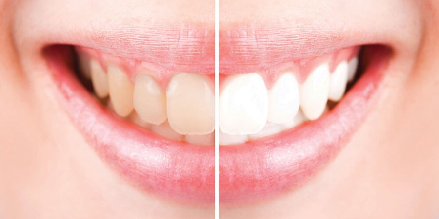 Teeth Whitening Kanata